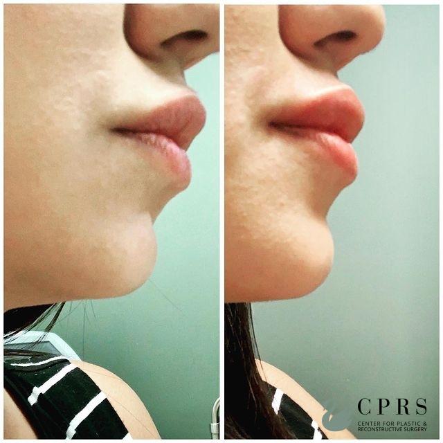 Fillers: Patient 8 - Before and After  
