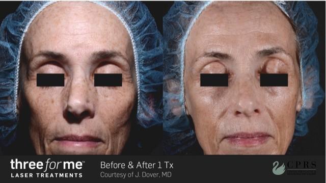 Laser: Patient 13 - Before and After 