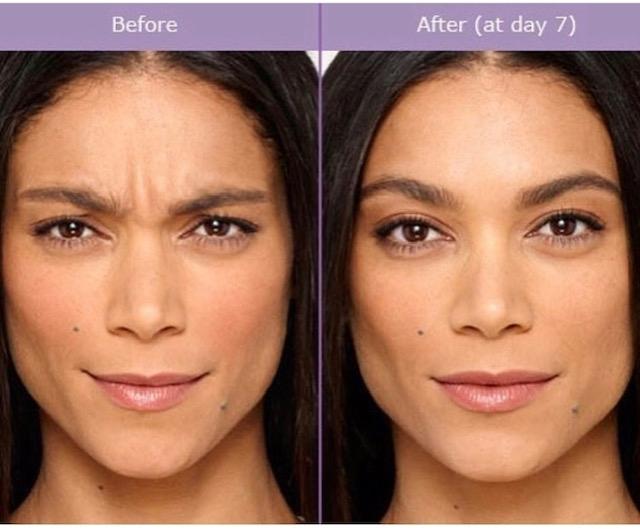 BOTOX® Cosmetic: Patient 1 - Before and After  