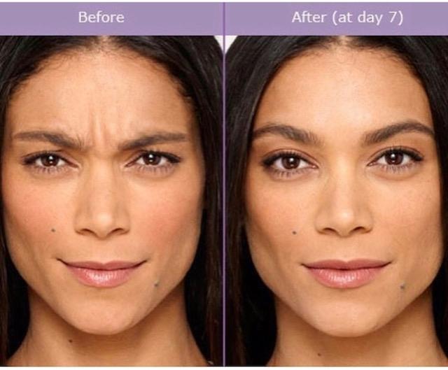 BOTOX® Cosmetic: Patient 2 - Before and After  