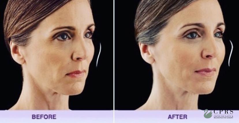 Fillers: Patient 9 - Before and After  