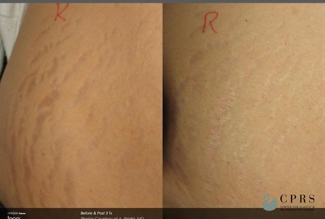 Laser: Patient 14 - Before and After 