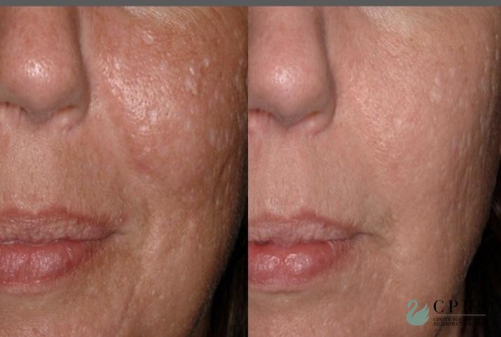Laser: Patient 10 - Before and After  