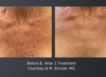 Laser: Patient 8 - Before and After  