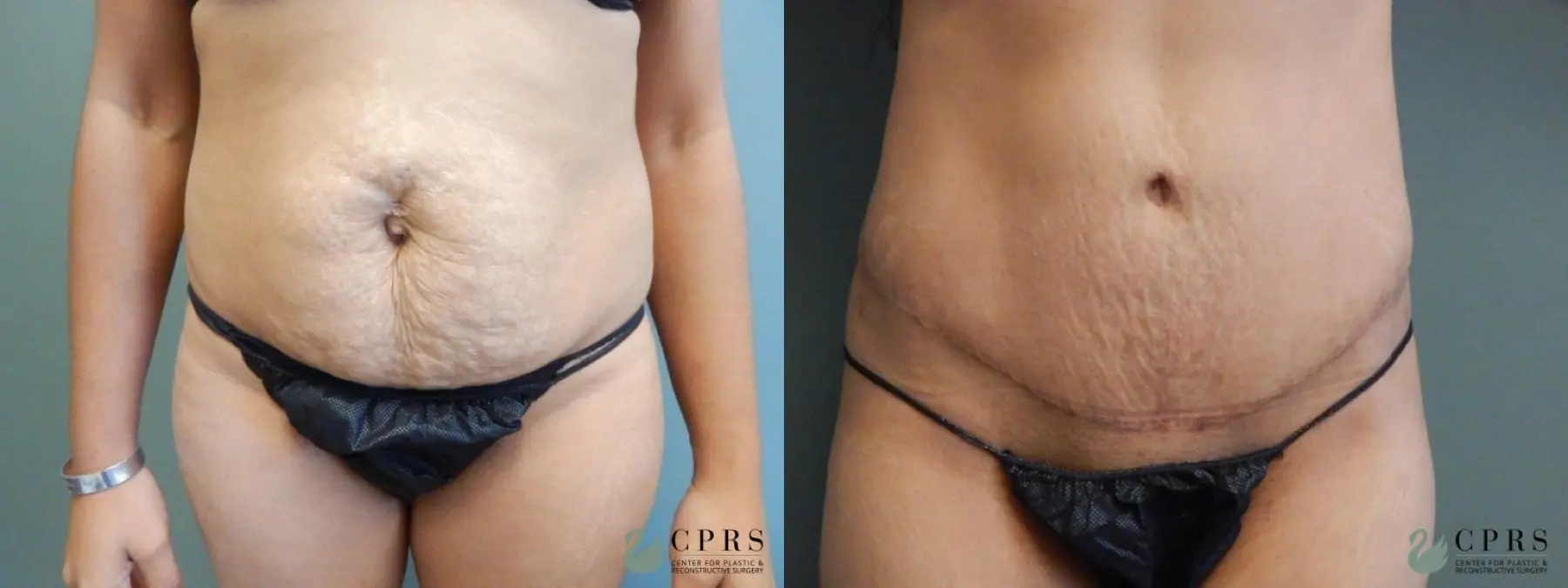 Abdominoplasty: Patient 5 - Before and After  
