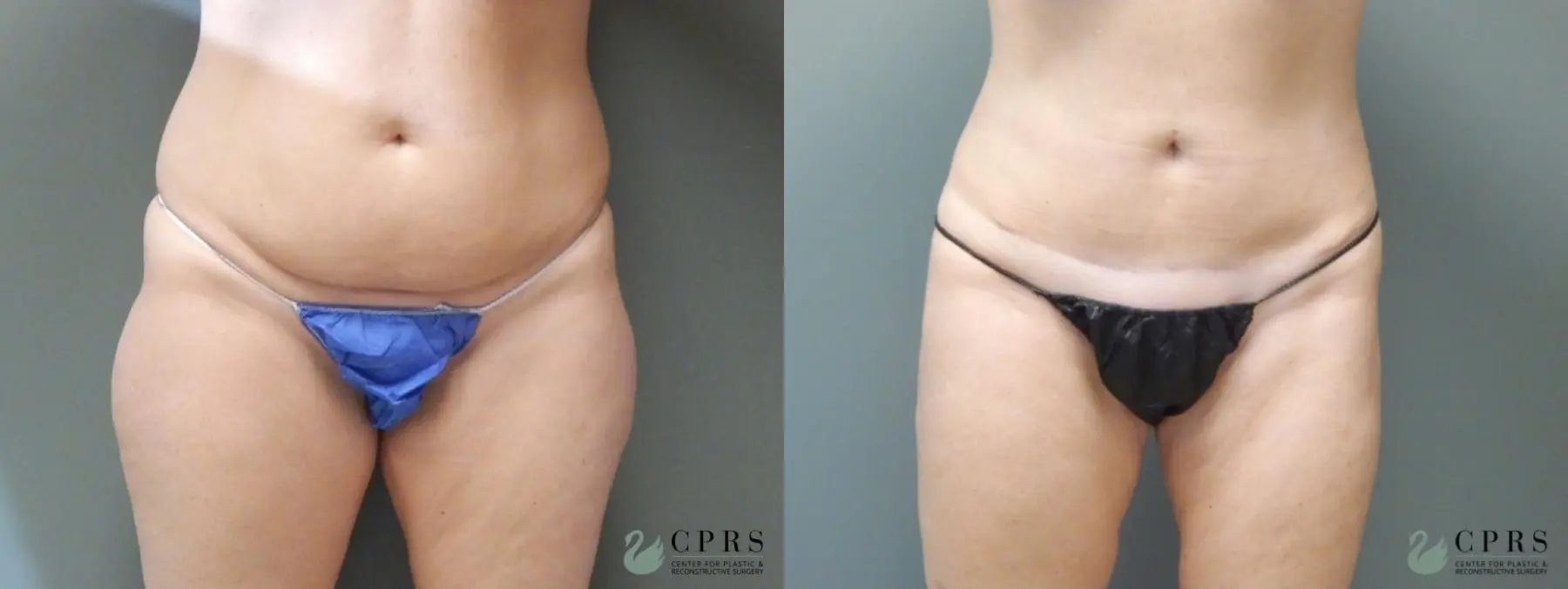 Abdominoplasty: Patient 19 - Before and After  