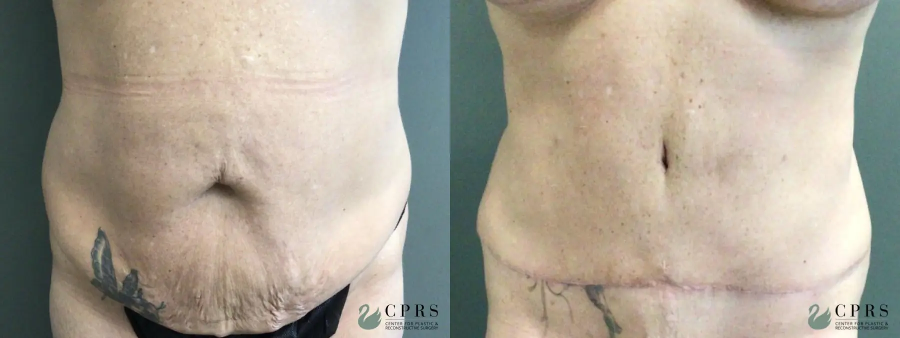 Abdominoplasty: Patient 17 - Before and After  