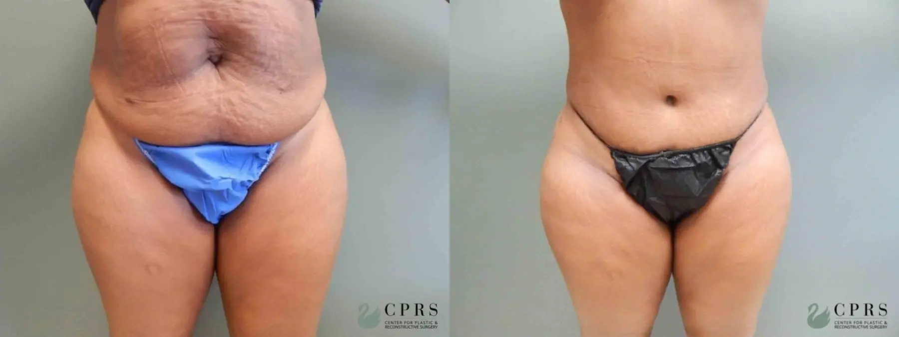 Abdominoplasty: Patient 6 - Before and After  