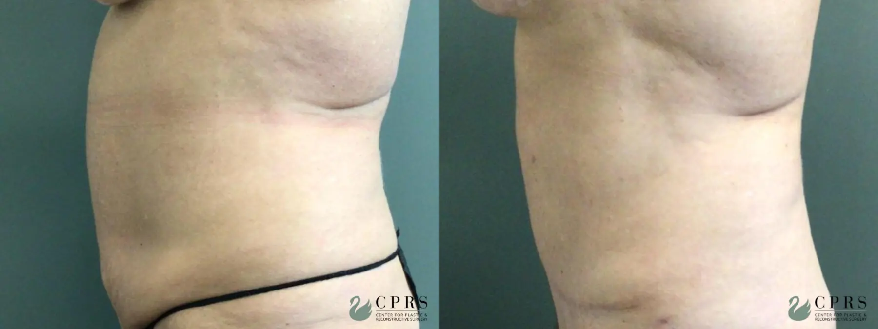 Abdominoplasty: Patient 18 - Before and After 3