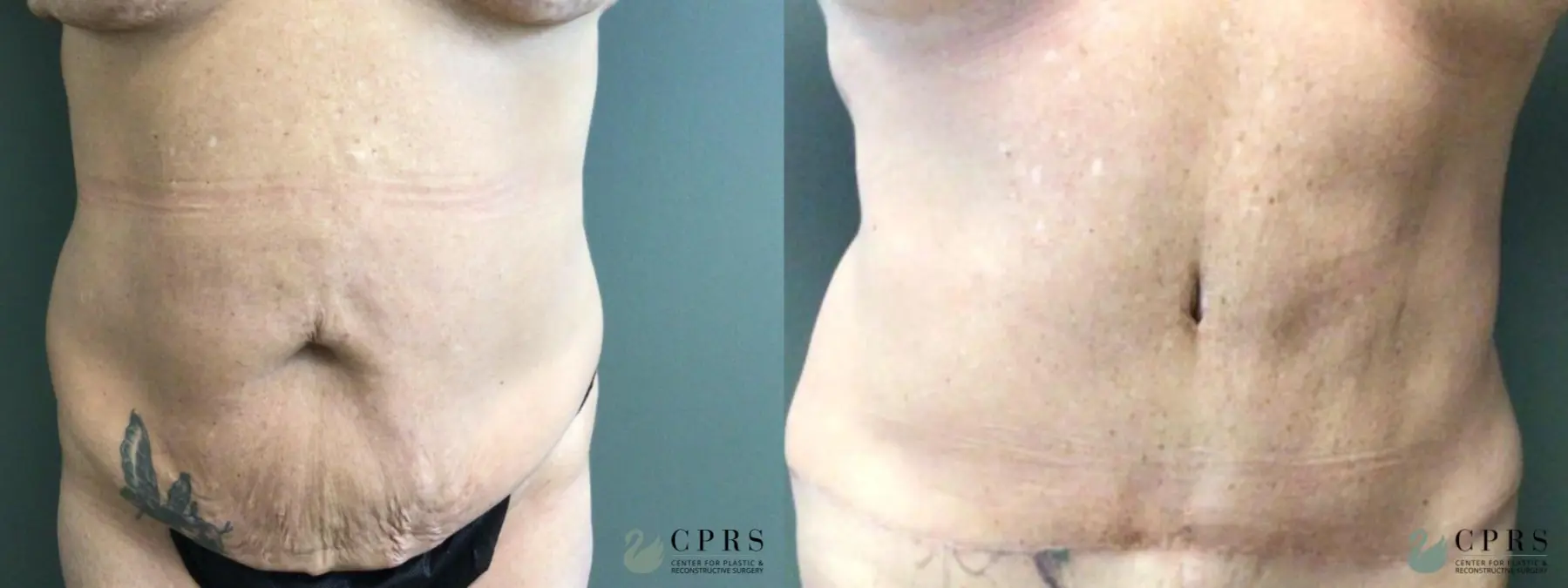 Abdominoplasty: Patient 21 - Before and After  