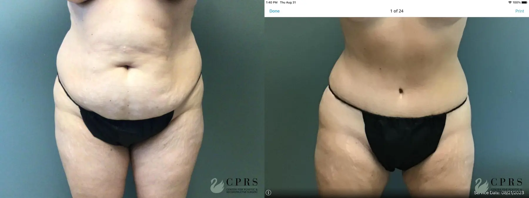 Abdominoplasty: Patient 25 - Before and After  