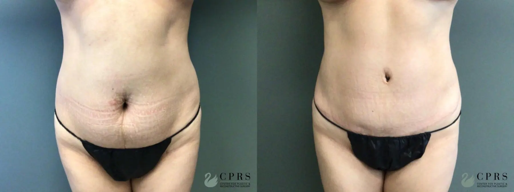 Abdominoplasty: Patient 28 - Before and After  