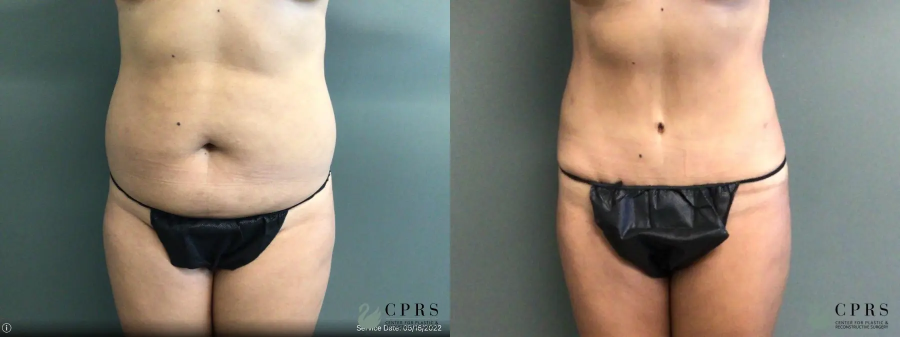 Abdominoplasty: Patient 22 - Before and After 1