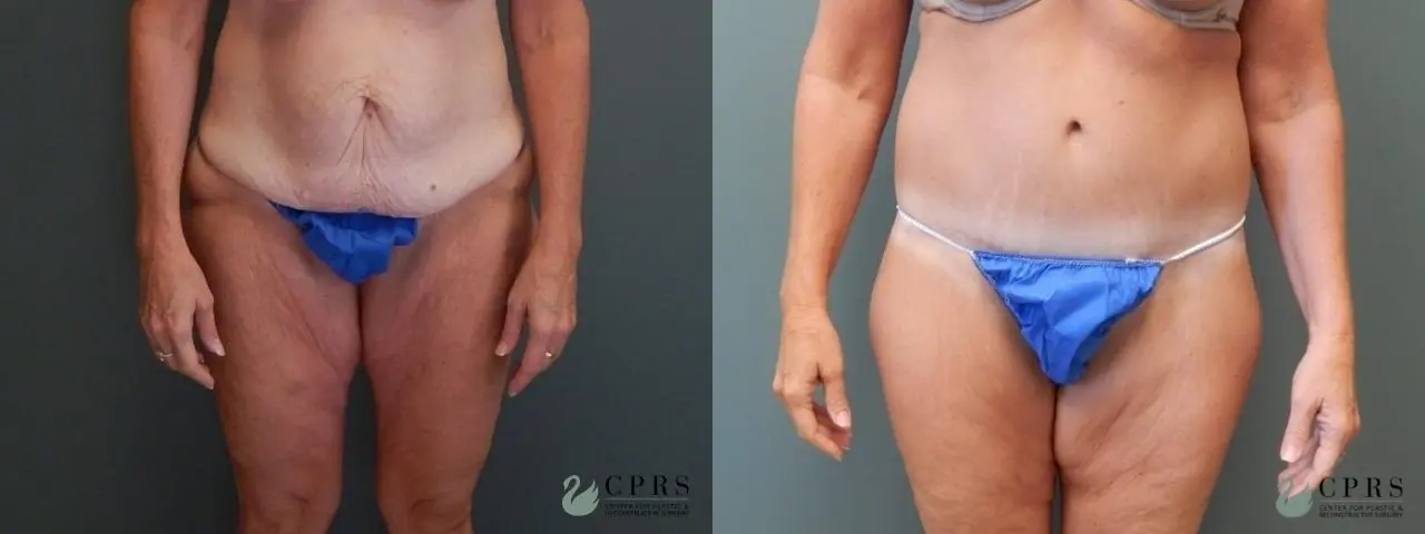 Abdominoplasty: Patient 9 - Before and After  