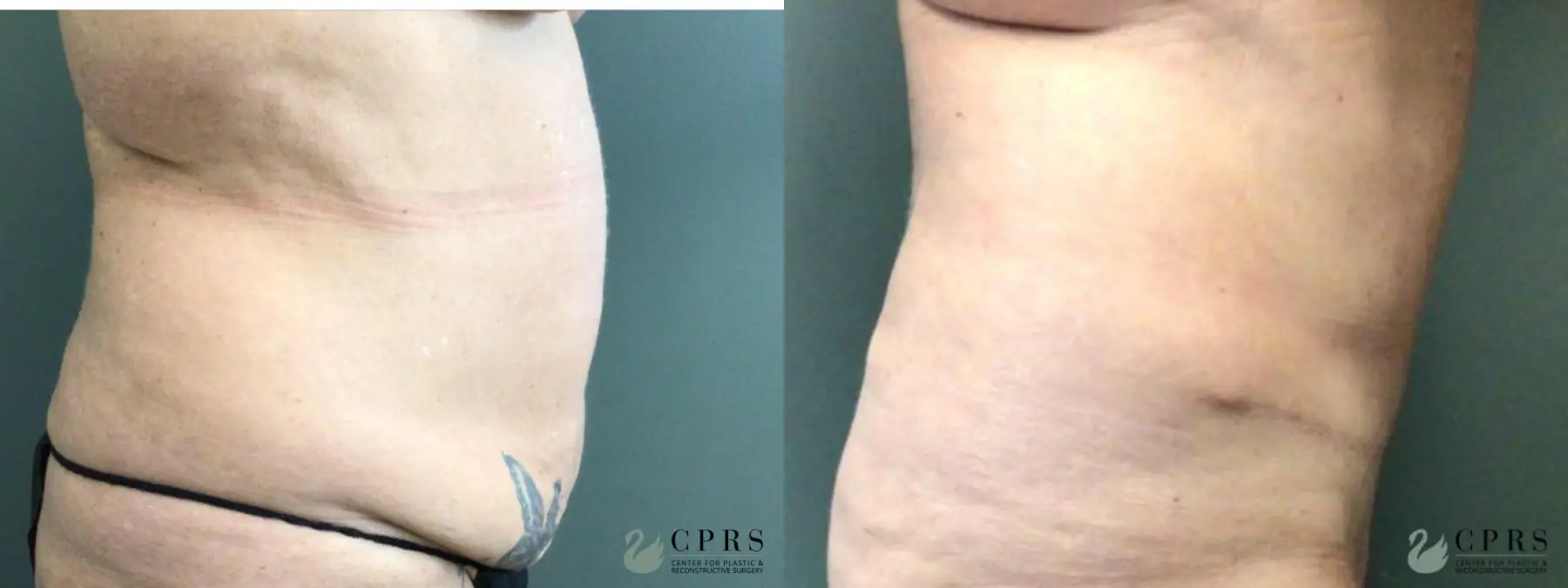 Abdominoplasty: Patient 18 - Before and After 2