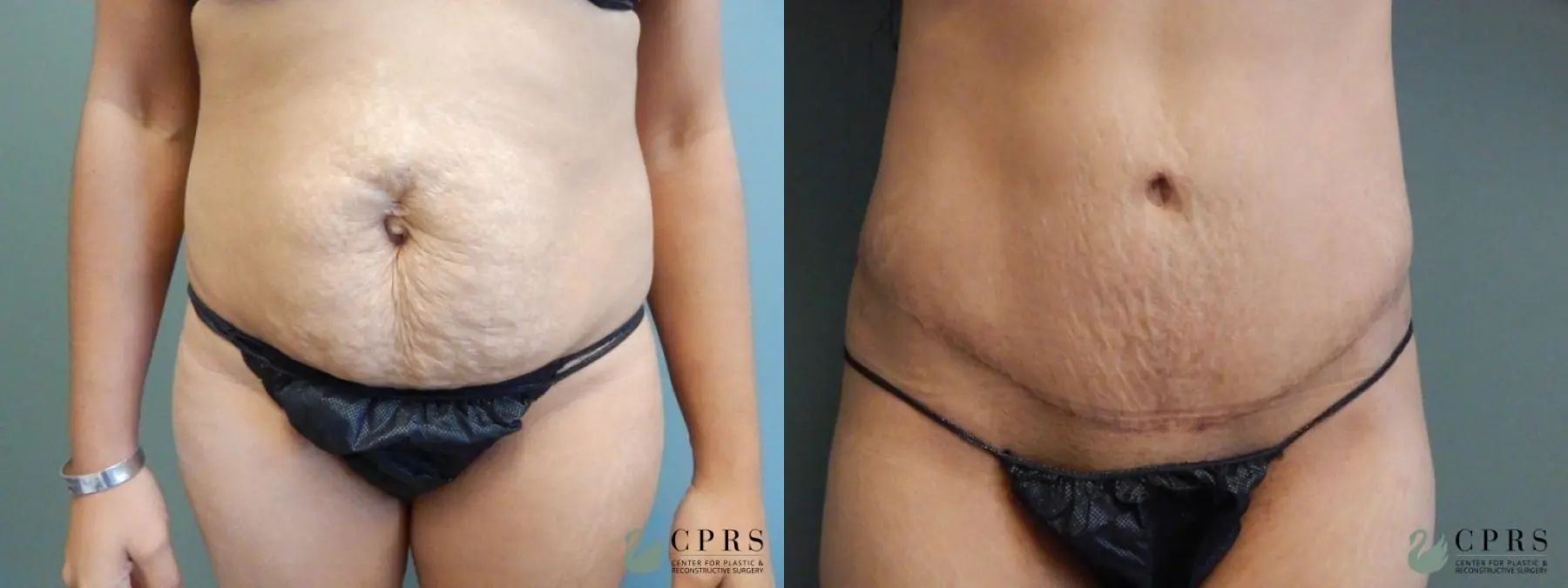Abdominoplasty: Patient 18 - Before and After  