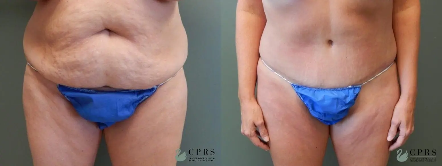 Abdominoplasty: Patient 15 - Before and After  