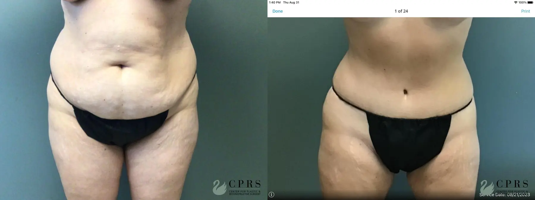 Abdominoplasty: Patient 24 - Before and After  