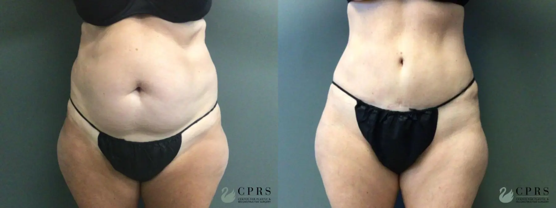Abdominoplasty: Patient 20 - Before and After  