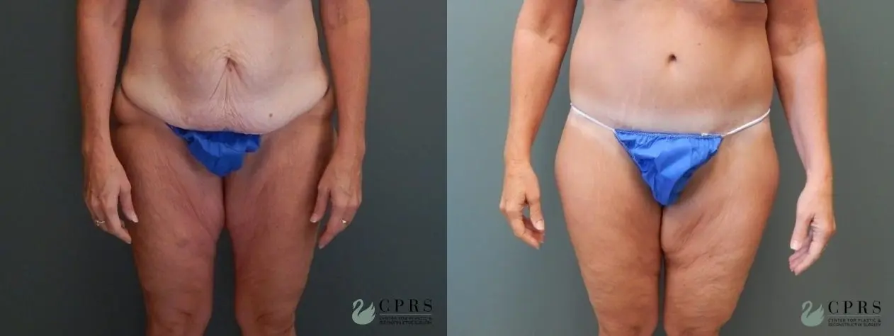 Abdominoplasty: Patient 10 - Before and After  