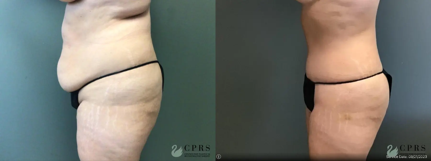 Abdominoplasty: Patient 21 - Before and After 3