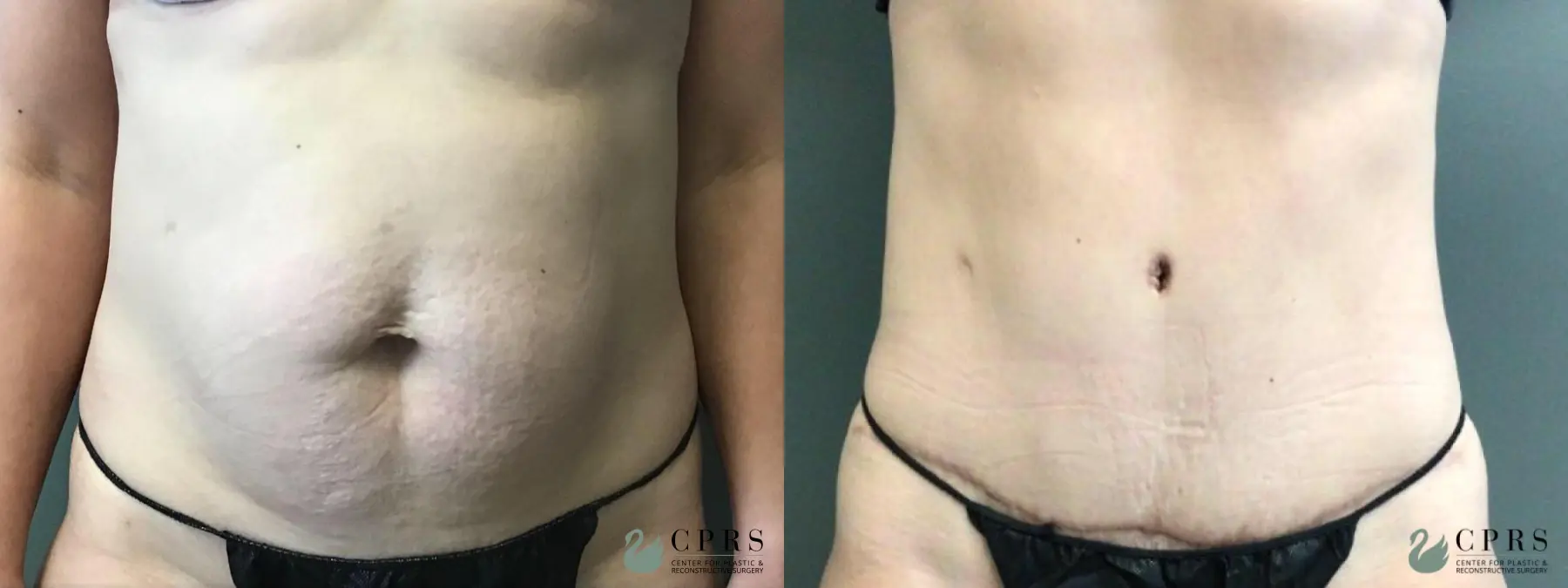 Abdominoplasty: Patient 5 - Before and After  