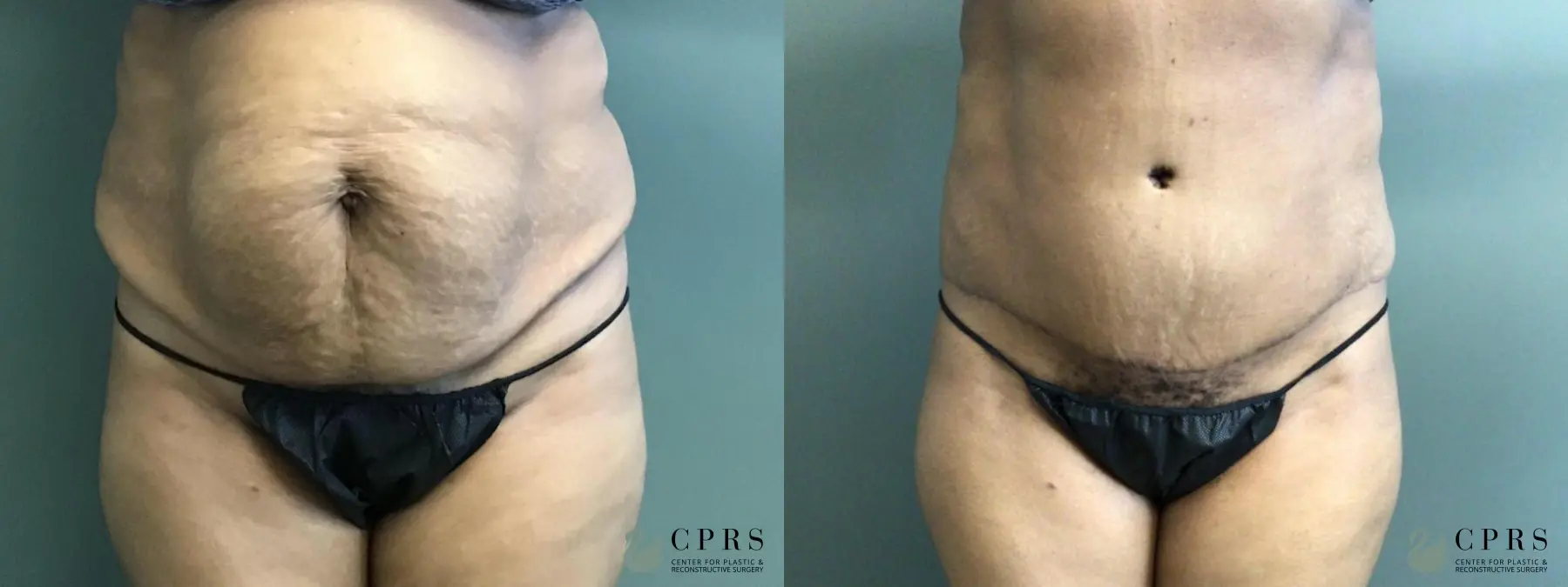 Abdominoplasty: Patient 9 - Before and After  