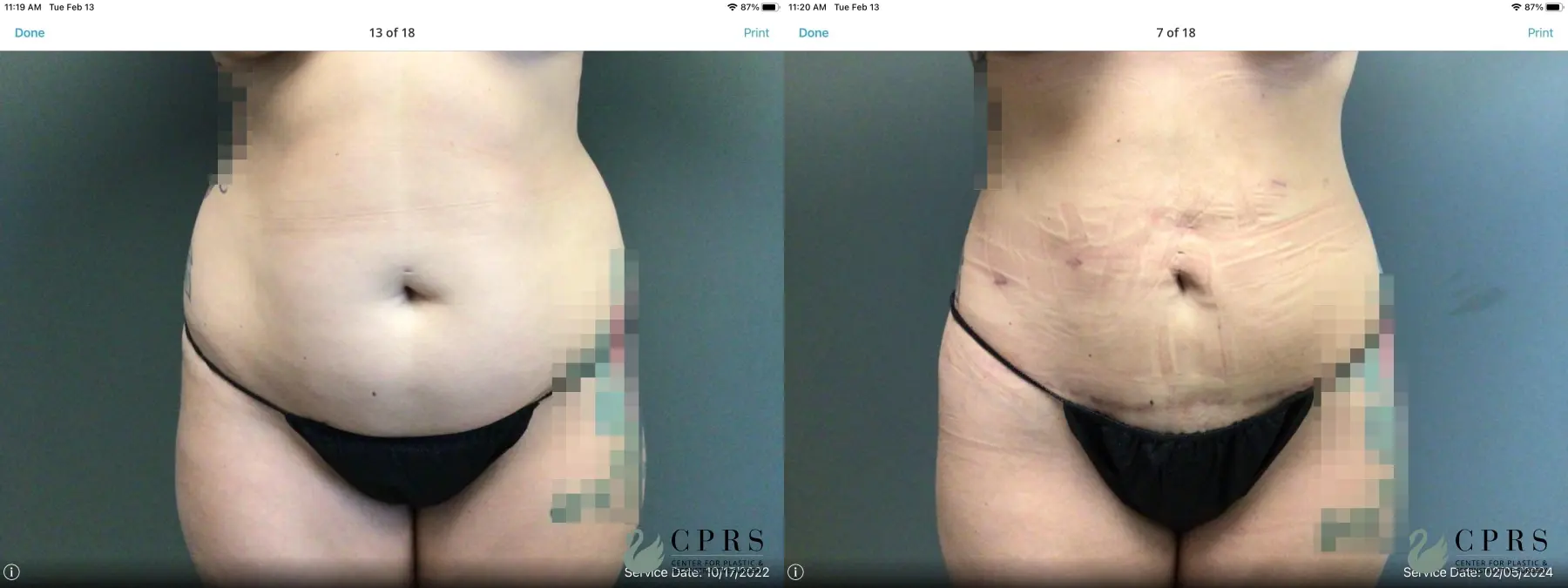 Abdominoplasty: Patient 27 - Before and After  