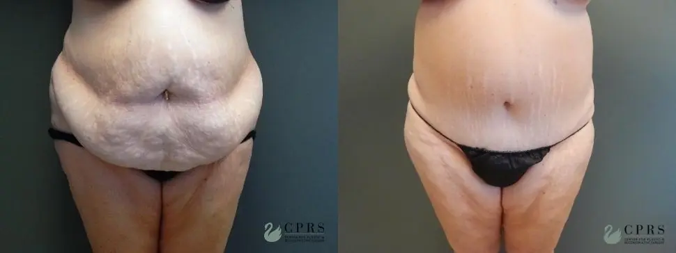 Abdominoplasty: Patient 8 - Before and After  