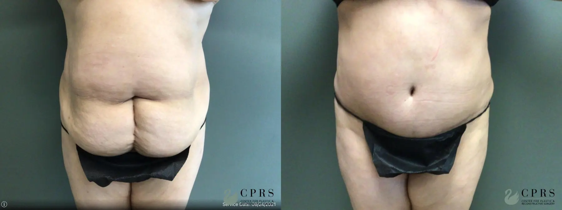 Abdominoplasty: Patient 23 - Before and After  