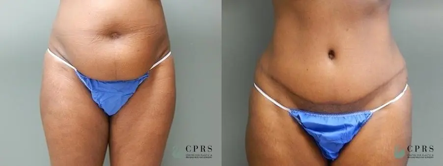 Abdominoplasty: Patient 4 - Before and After  
