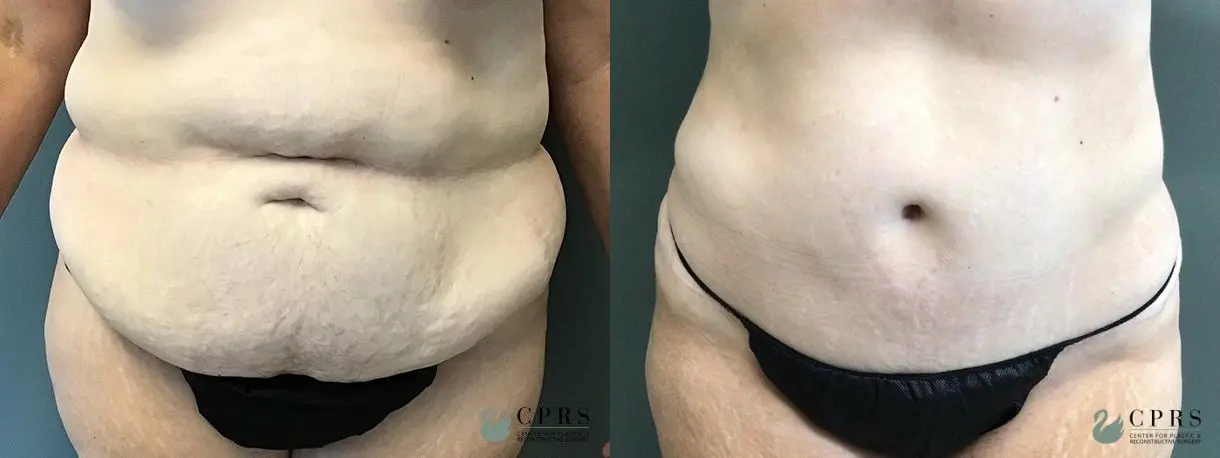 Abdominoplasty: Patient 7 - Before and After  