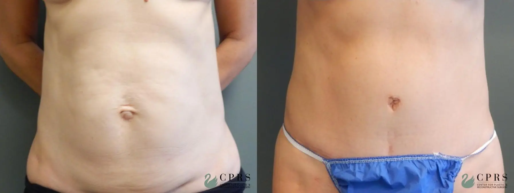 Abdominoplasty: Patient 14 - Before and After  