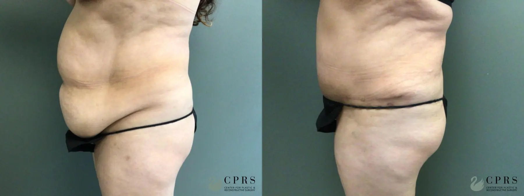 Abdominoplasty: Patient 20 - Before and After 2