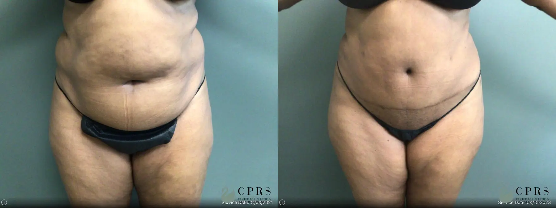 Abdominoplasty: Patient 22 - Before and After  