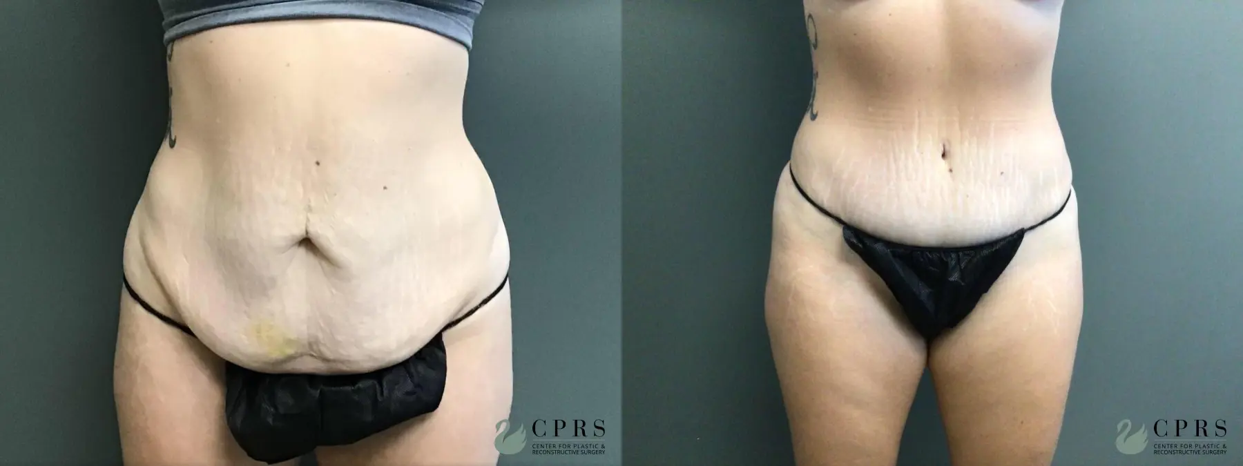 Abdominoplasty: Patient 2 - Before and After  