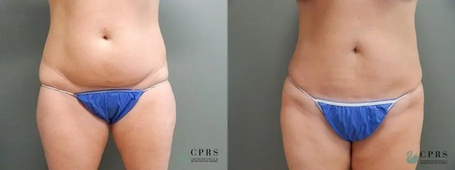 Abdominoplasty: Patient 16 - Before and After  
