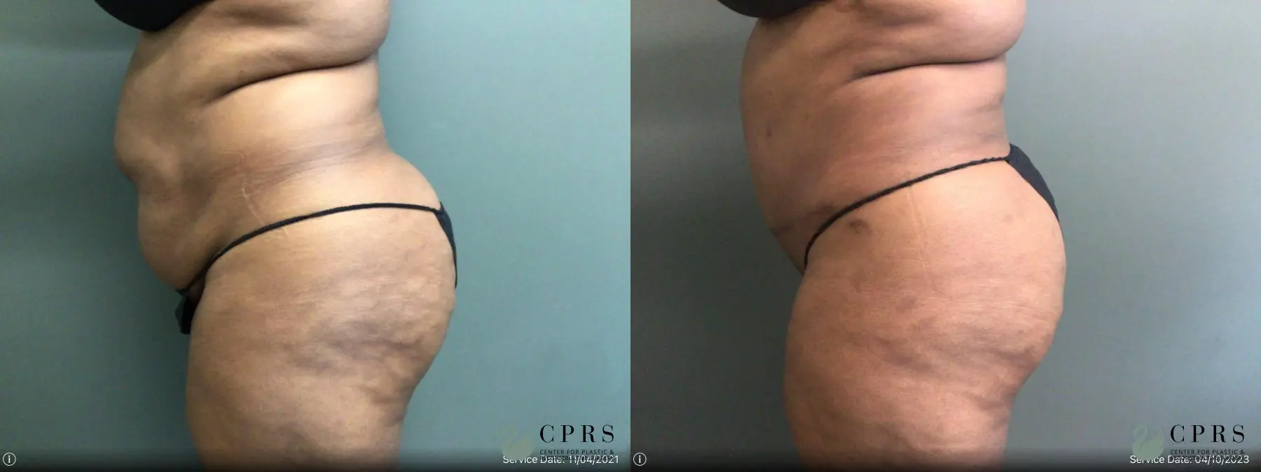 Abdominoplasty: Patient 19 - Before and After 2