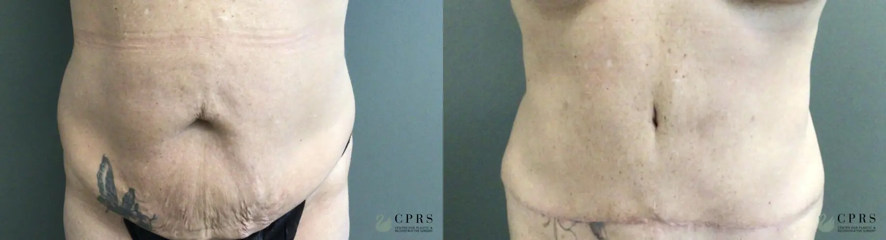 Abdominoplasty: Patient 20 - Before and After  