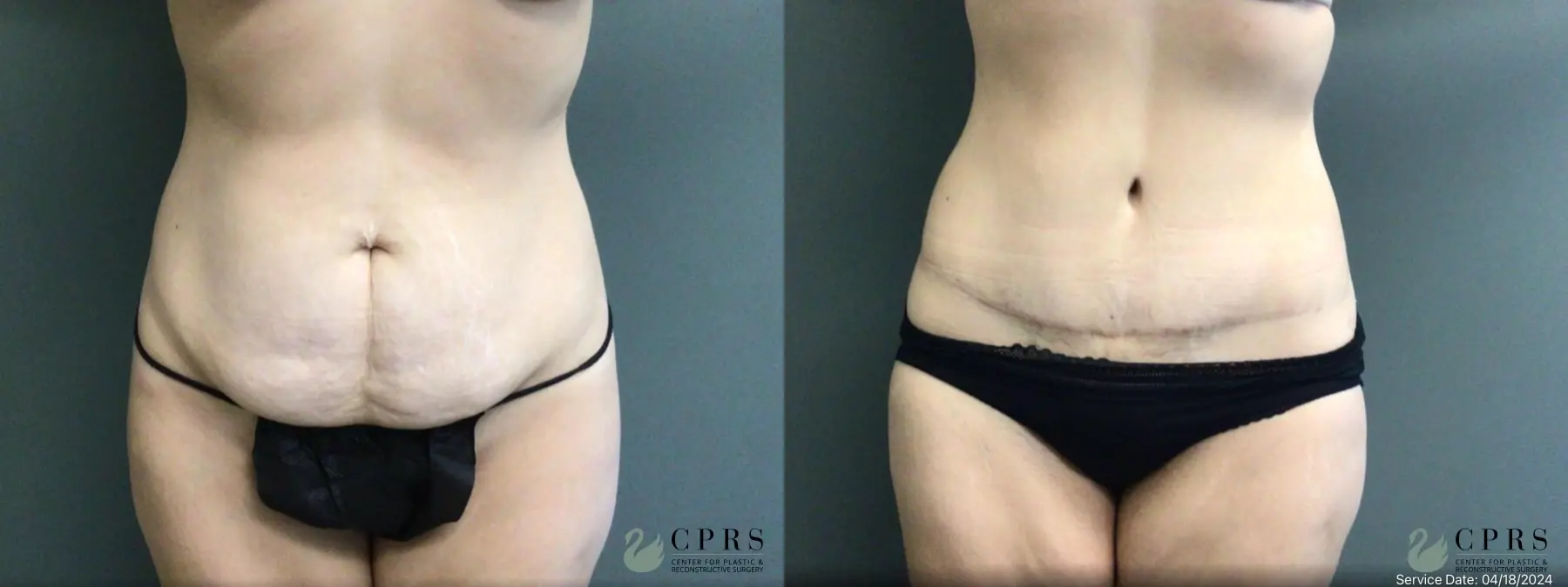 Abdominoplasty: Patient 29 - Before and After  