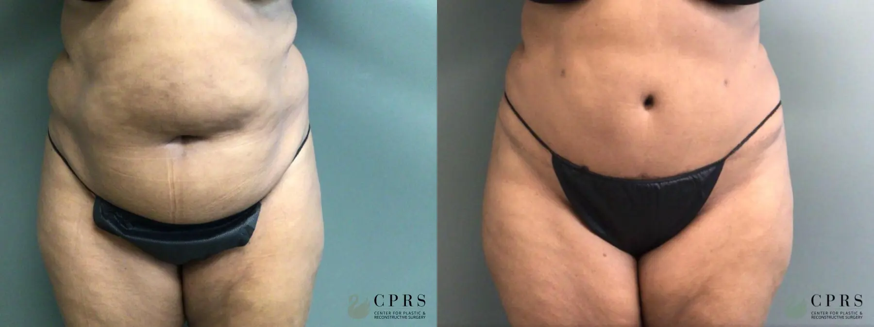Abdominoplasty: Patient 30 - Before and After  
