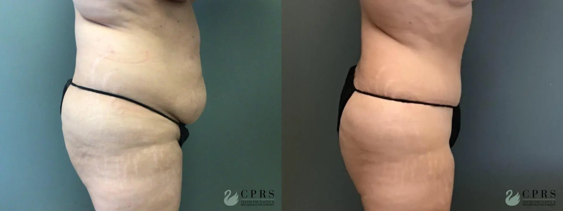 Abdominoplasty: Patient 21 - Before and After 2