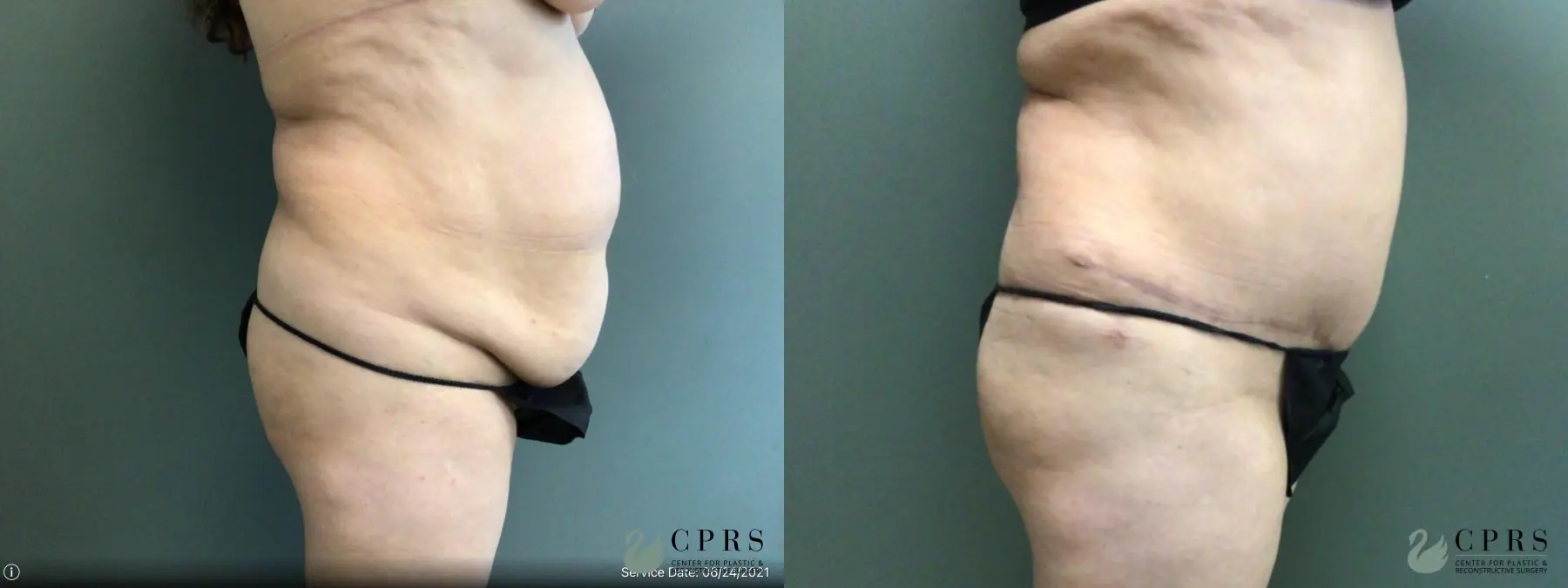 Abdominoplasty: Patient 20 - Before and After 3