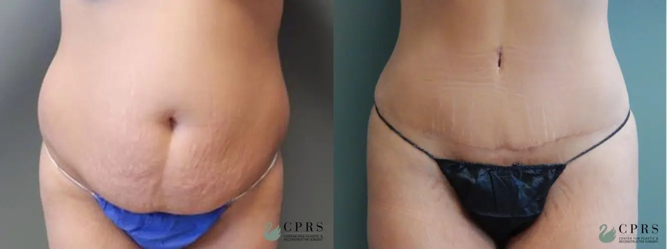 Abdominoplasty: Patient 13 - Before and After  