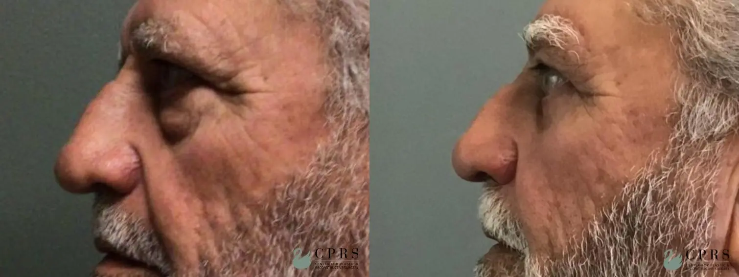 Blepharoplasty: Patient 12 - Before and After  