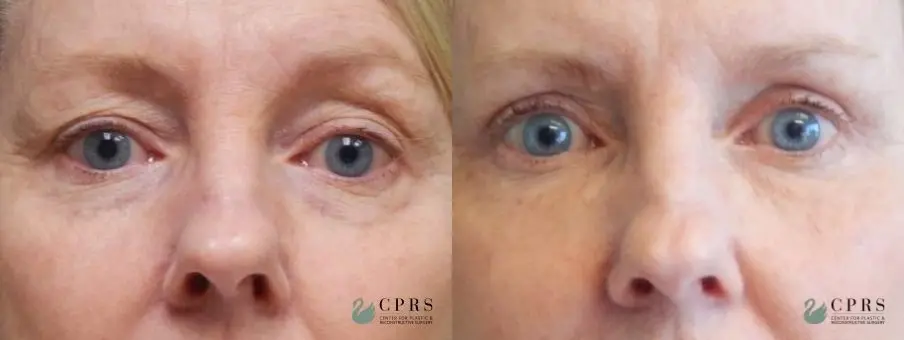 Blepharoplasty: Patient 5 - Before and After  