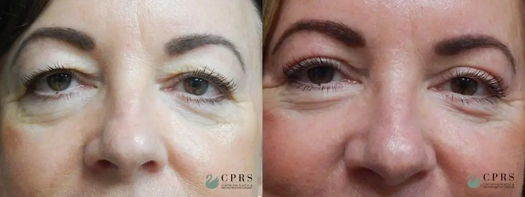 Blepharoplasty: Patient 4 - Before and After  