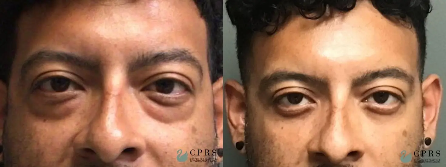 Blepharoplasty: Patient 11 - Before and After  