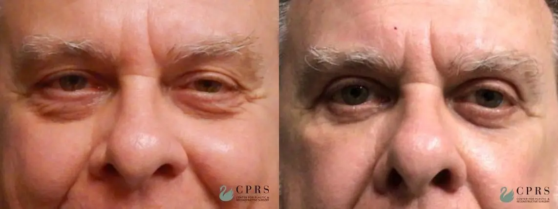 Blepharoplasty: Patient 7 - Before and After  