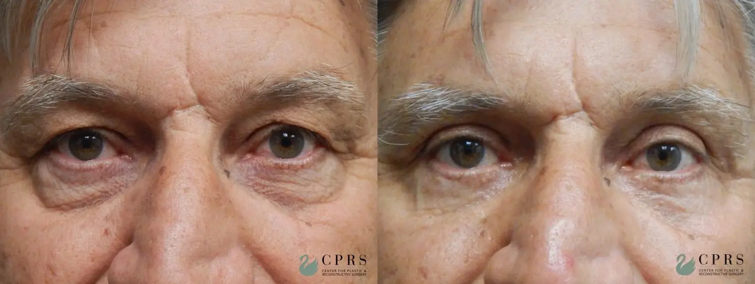 Blepharoplasty: Patient 2 - Before and After  